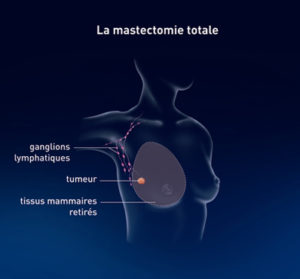 Schéma d'une mastectomie