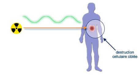 Schéma de la radiothéraie